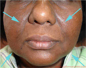 Multipolar-RF-Before